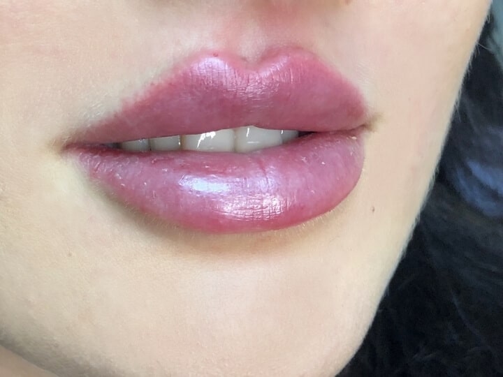 Das Bild zeigt eine Frau mit Russian Lips (Doll Lips) und verdeutlicht die Lippenvergrößerung.